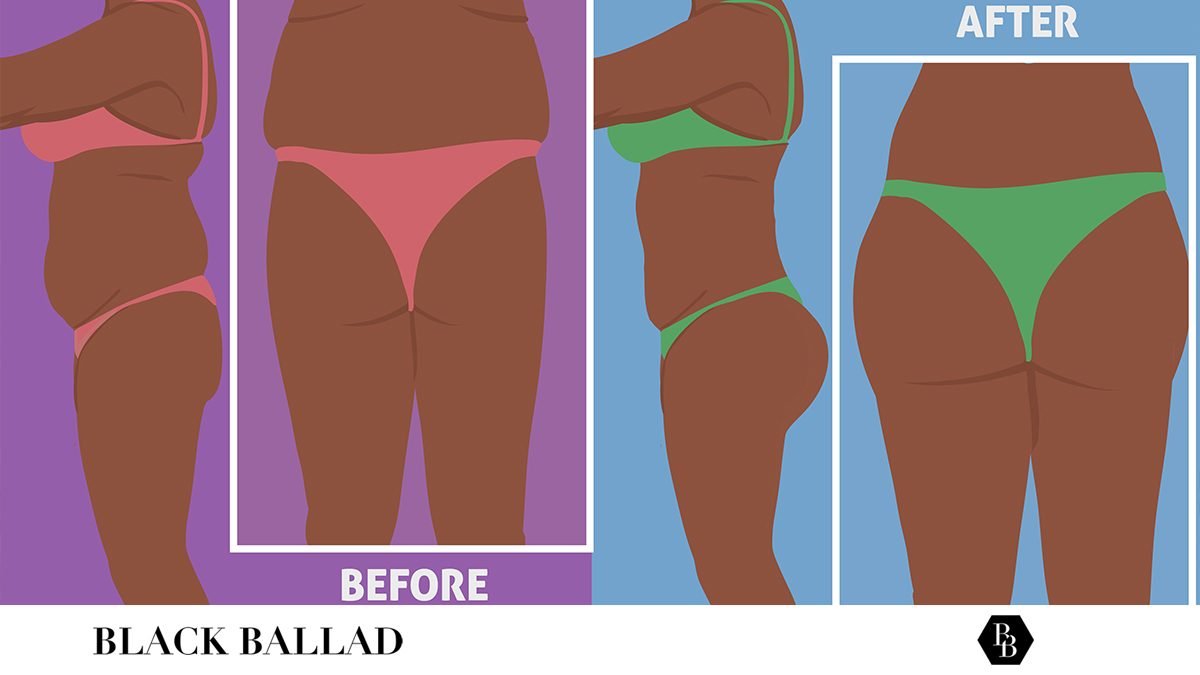 The Rise & Real Dangers Behind Brazilian Butt Lifts